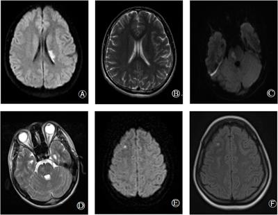 Analysis of cerebral infarction caused by dysplasminogenemia in three pedigrees